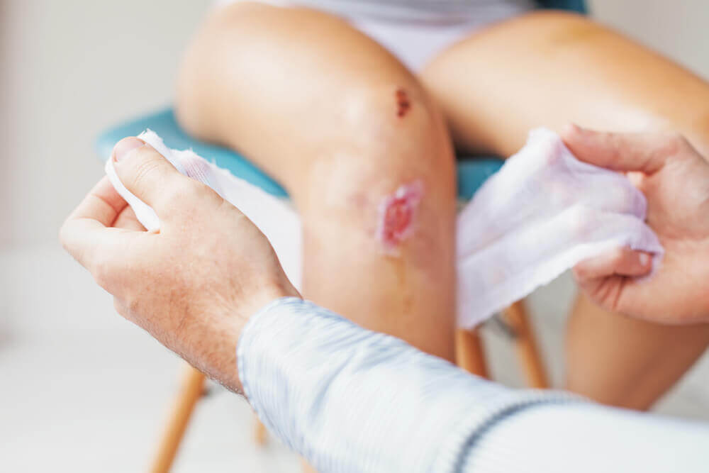 Scar on a leg.