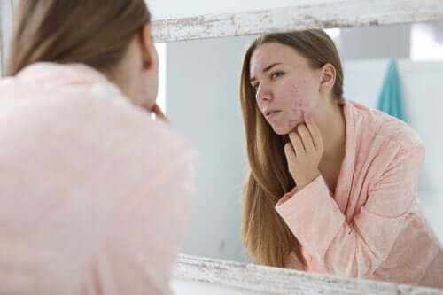 Hormonal Acne: Causes and Treatment Options