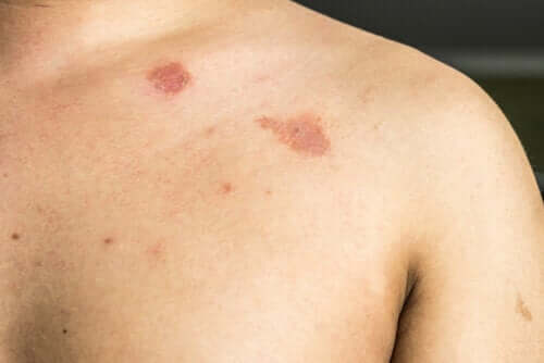 Description and Characteristics of Pityriasis Versicolor