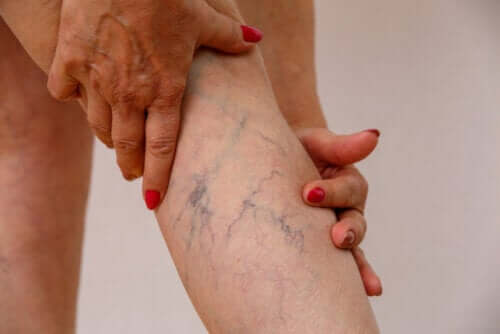 Description of Phlebitis and Its Symptoms and Treatment