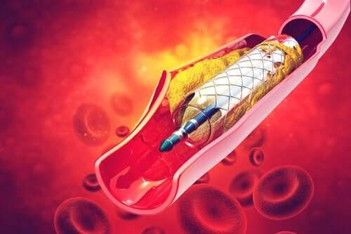 Stents in Arteries: Everything you Need to Know