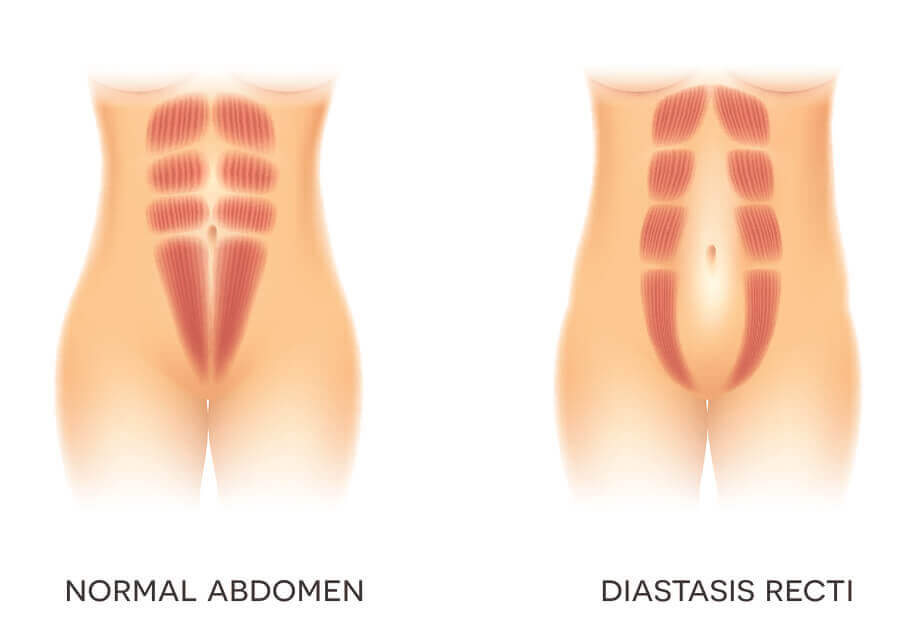 A normal abdomen and one with diastasis recti.