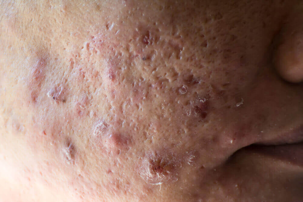 A face with acne.