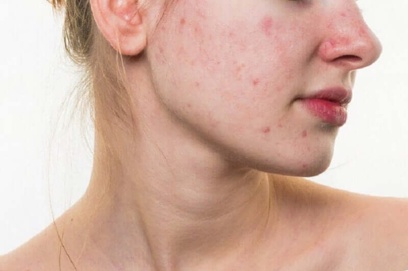 A woman with cystic acne.