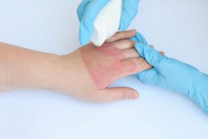 Steam and Hot Water Burns: Treatments and Recommendations