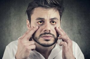 Gilbert's Syndrome: Symptoms and Treatment