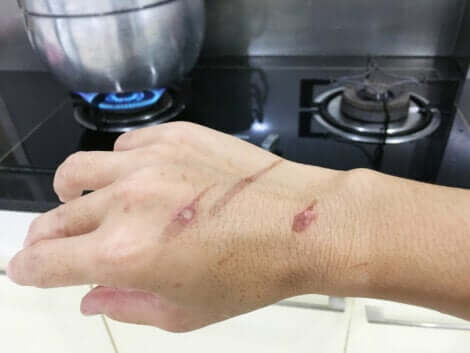 A man has a burn.