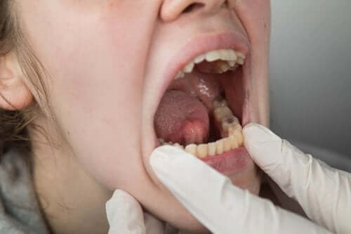 Risk Factors for Mouth Cancer