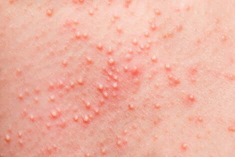Prickly heat on a baby's skin.