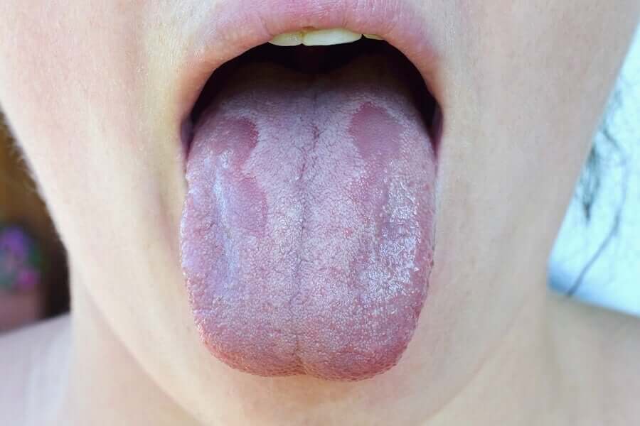 Tongue with bacterial infection.