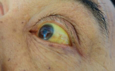 Yellow eyes from Gilbert's syndrome.