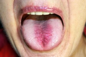 Burning Mouth Syndrome: Identification and Treatment