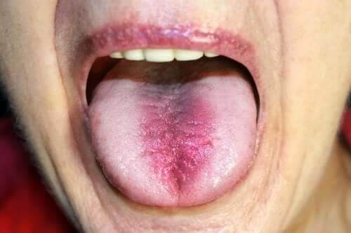 Burning Mouth Syndrome: Identification and Treatment