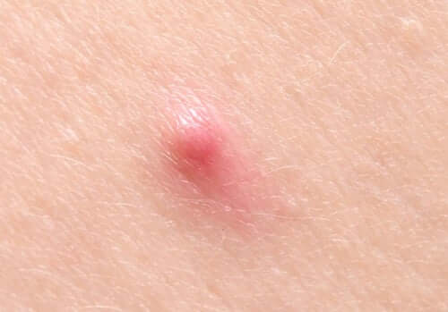 A cyst on the skin.