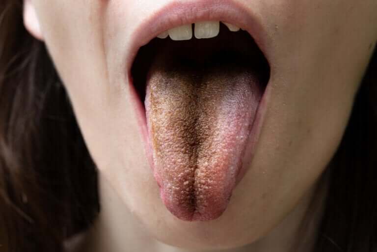 Black Hairy Tongue: Causes, Symptoms and Tips