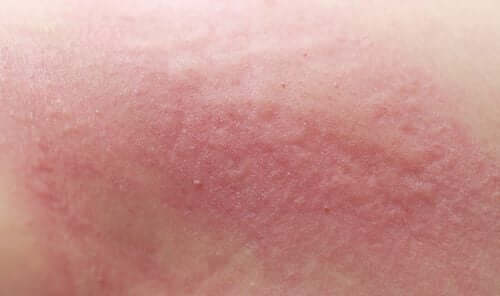 Myiasis