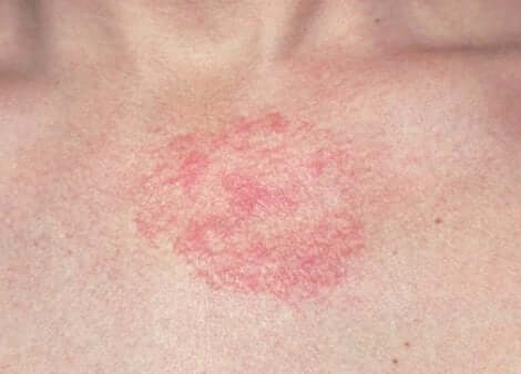 A skin rash.