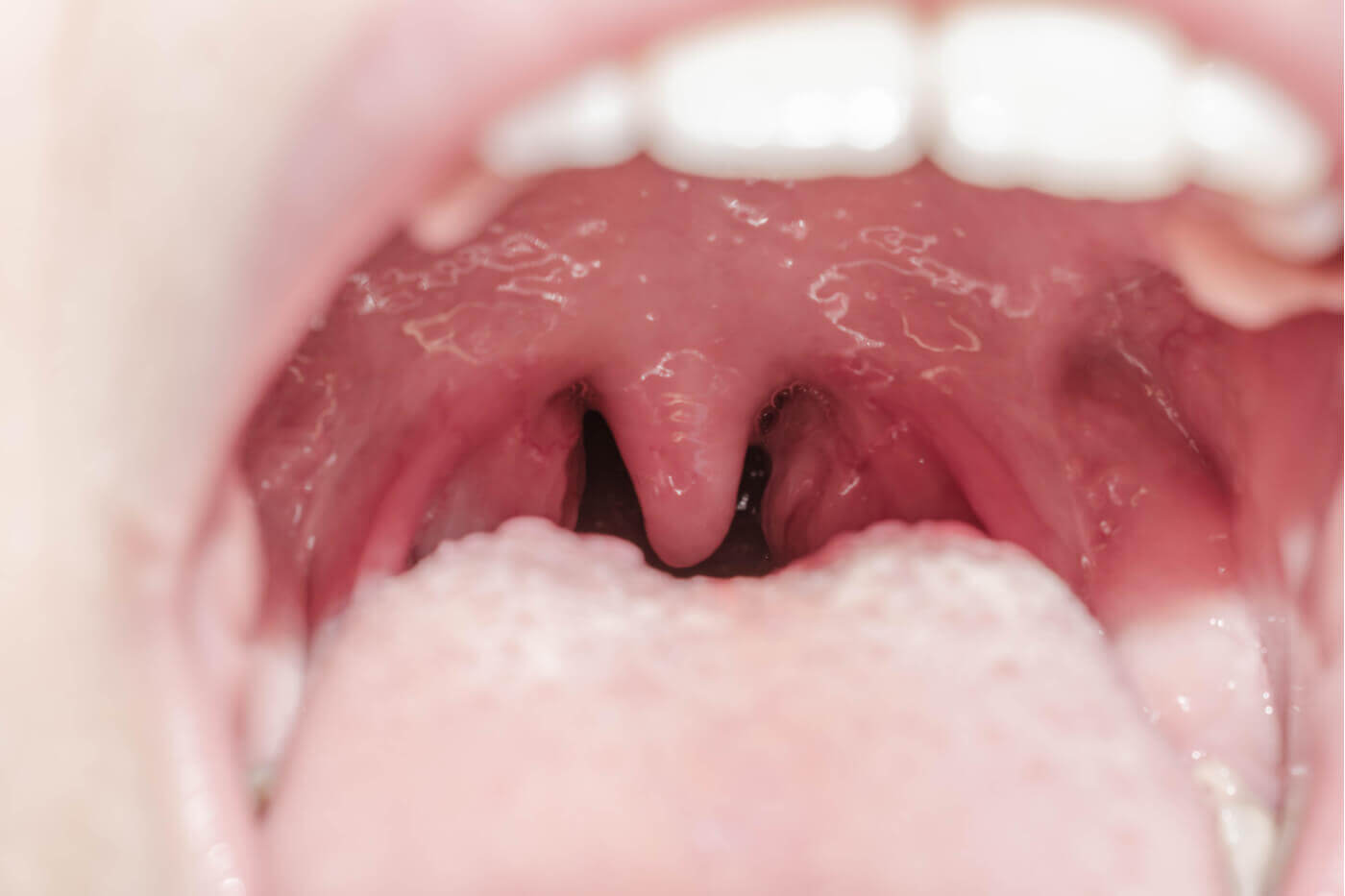 The uvula.