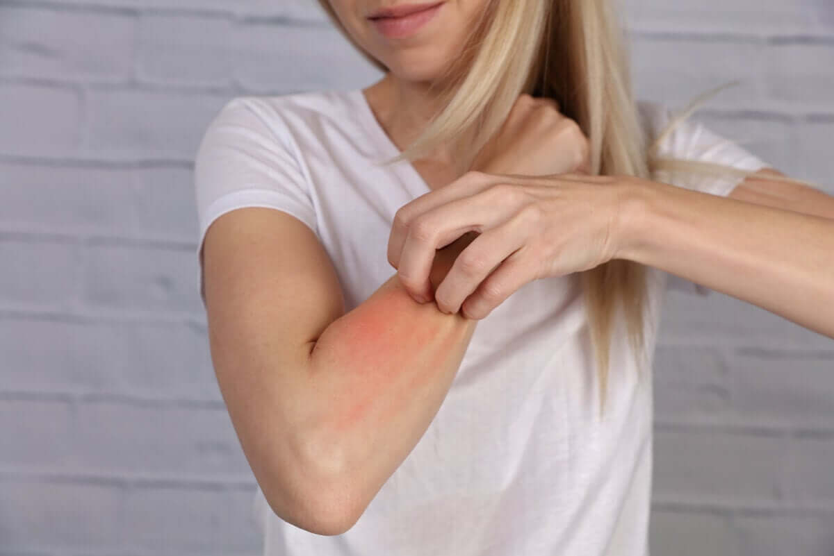 A woman with a skin rash.