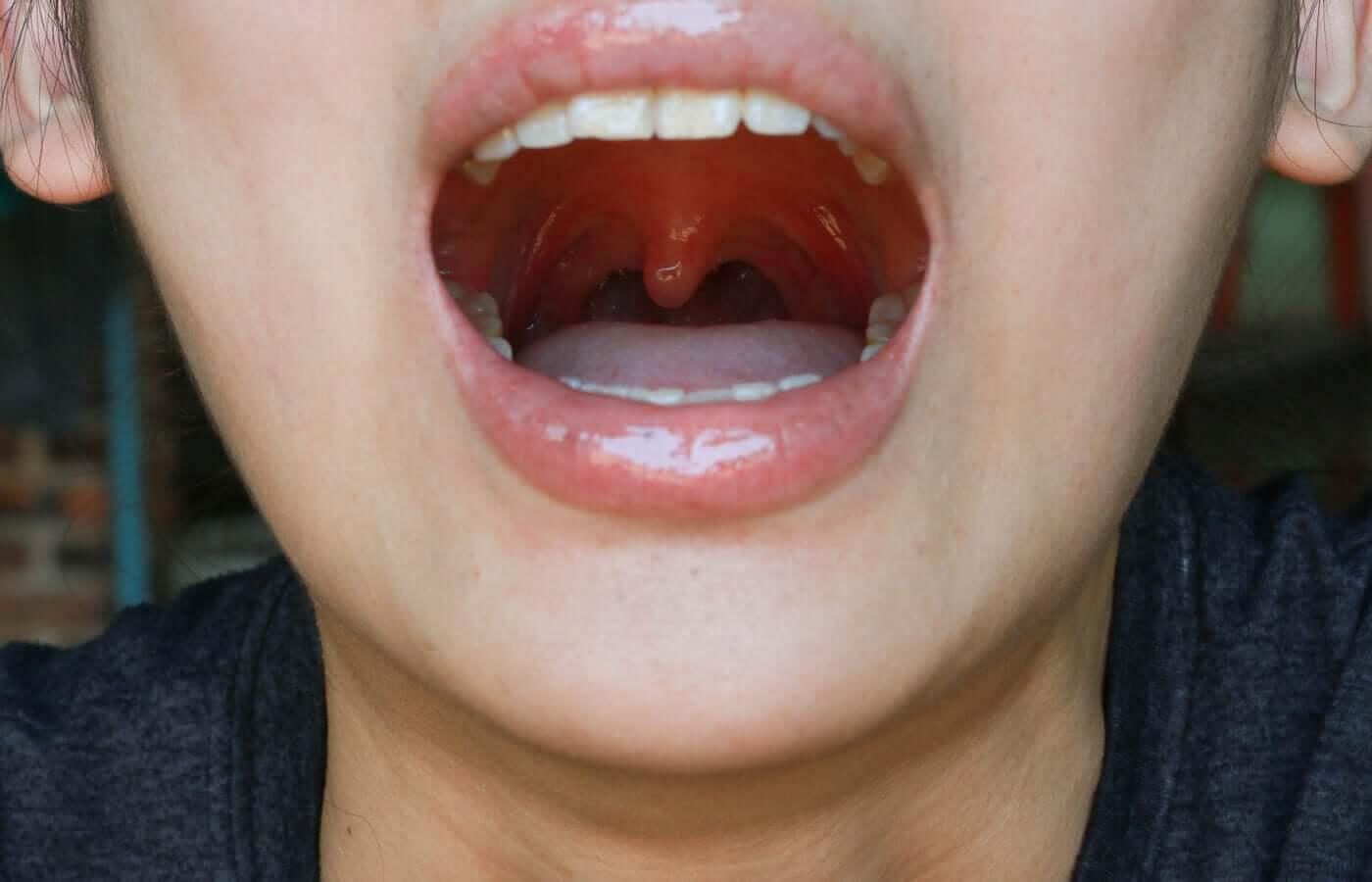 A woman with a swollen uvula.