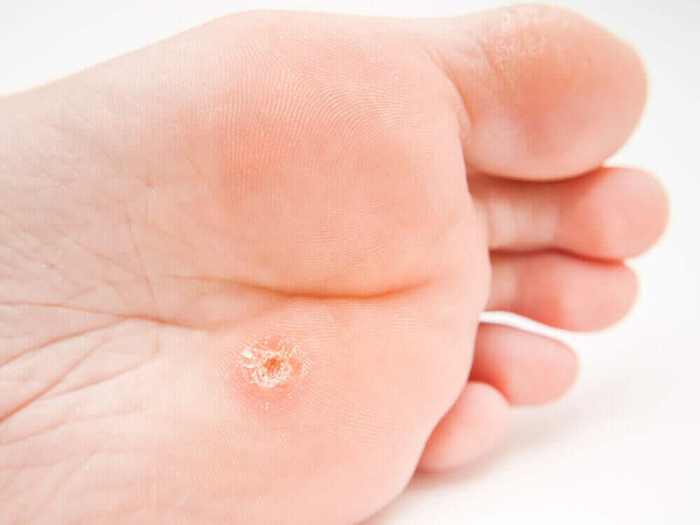 A foot wart on a foot.