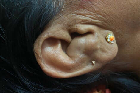 A woman with cauliflower ear.