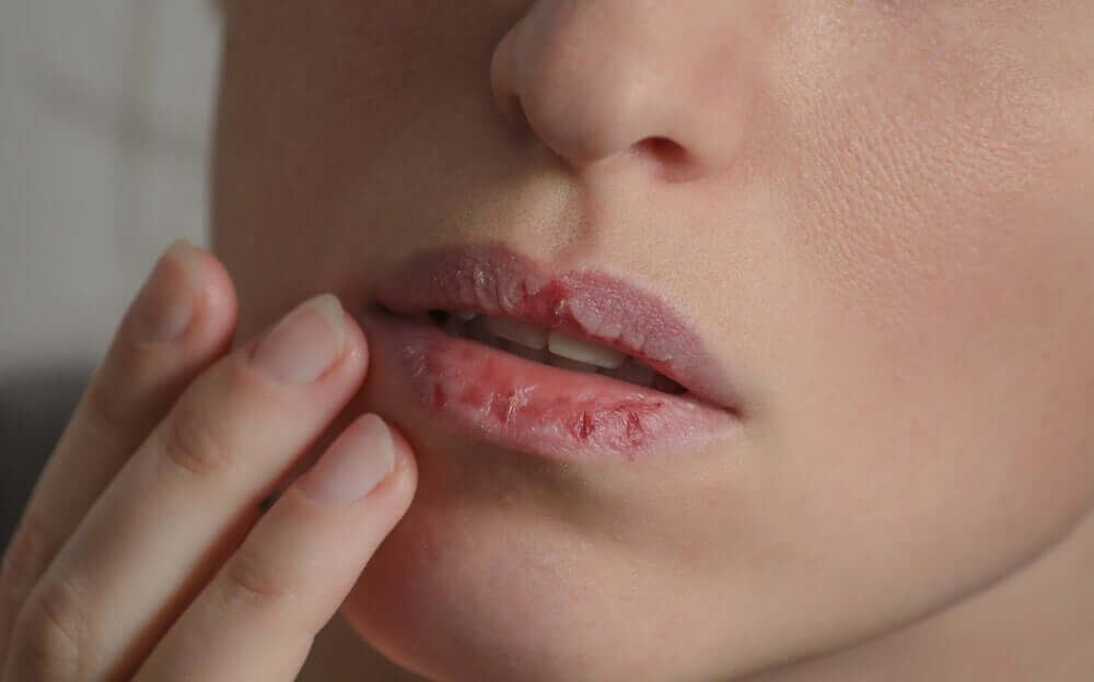 A woman with cold sores.