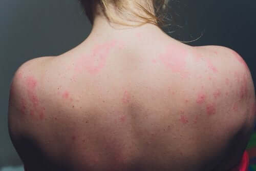Skin Conditions: What Is Actinodermatitis?