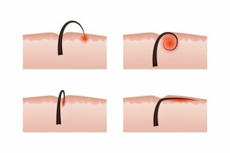 The Causes of Ingrown Hair and its Removal