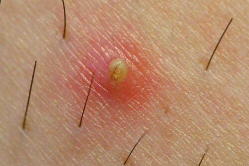 A pussy ingrown hair.