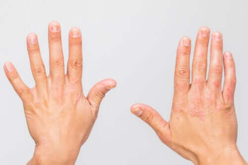 What Are Autoinflammatory Diseases?