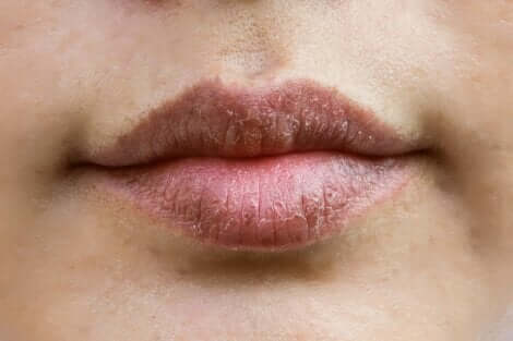 Chapped lips.