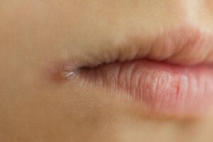 Why Do We Get Cold Sores?