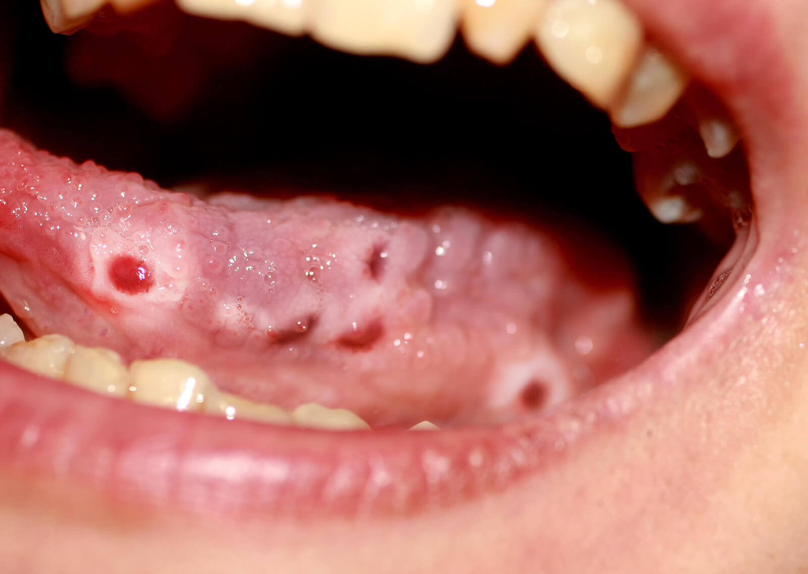 Cold sores on a tongue.