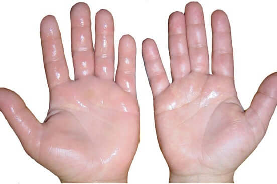 Sweaty hands.