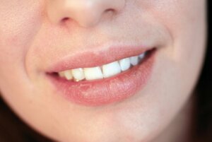 Causes of Dry Lips
