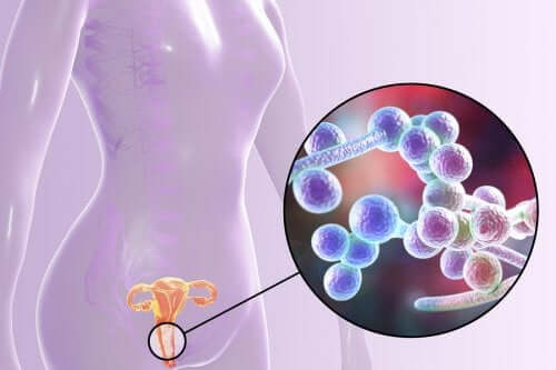 Candidiasis in the body.