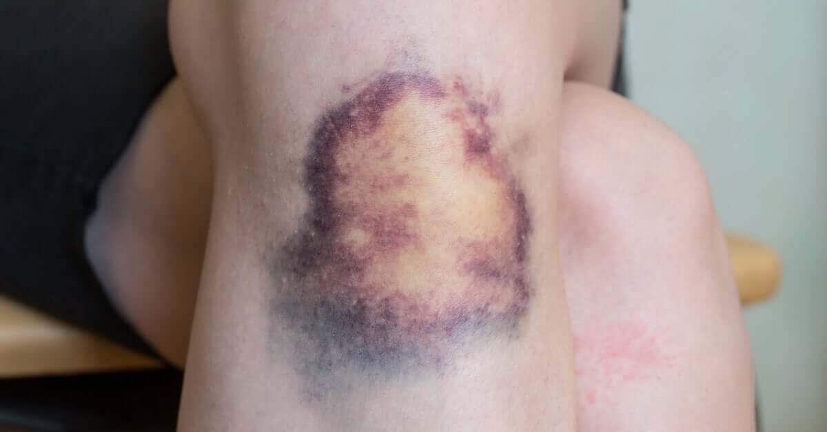 A patient with a very bruised knee.