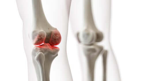 A digital representation of knee joint pain.