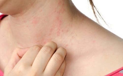 Symptomen van urticaria