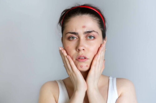 Kostholdet ditt kan påvirke huden din betydelig. På dette bildet, en kvinne som lider av akne.