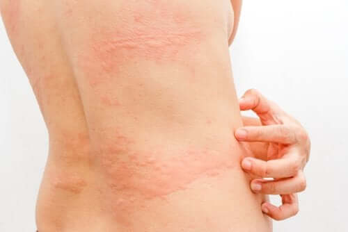 Vrouw met koude urticaria
