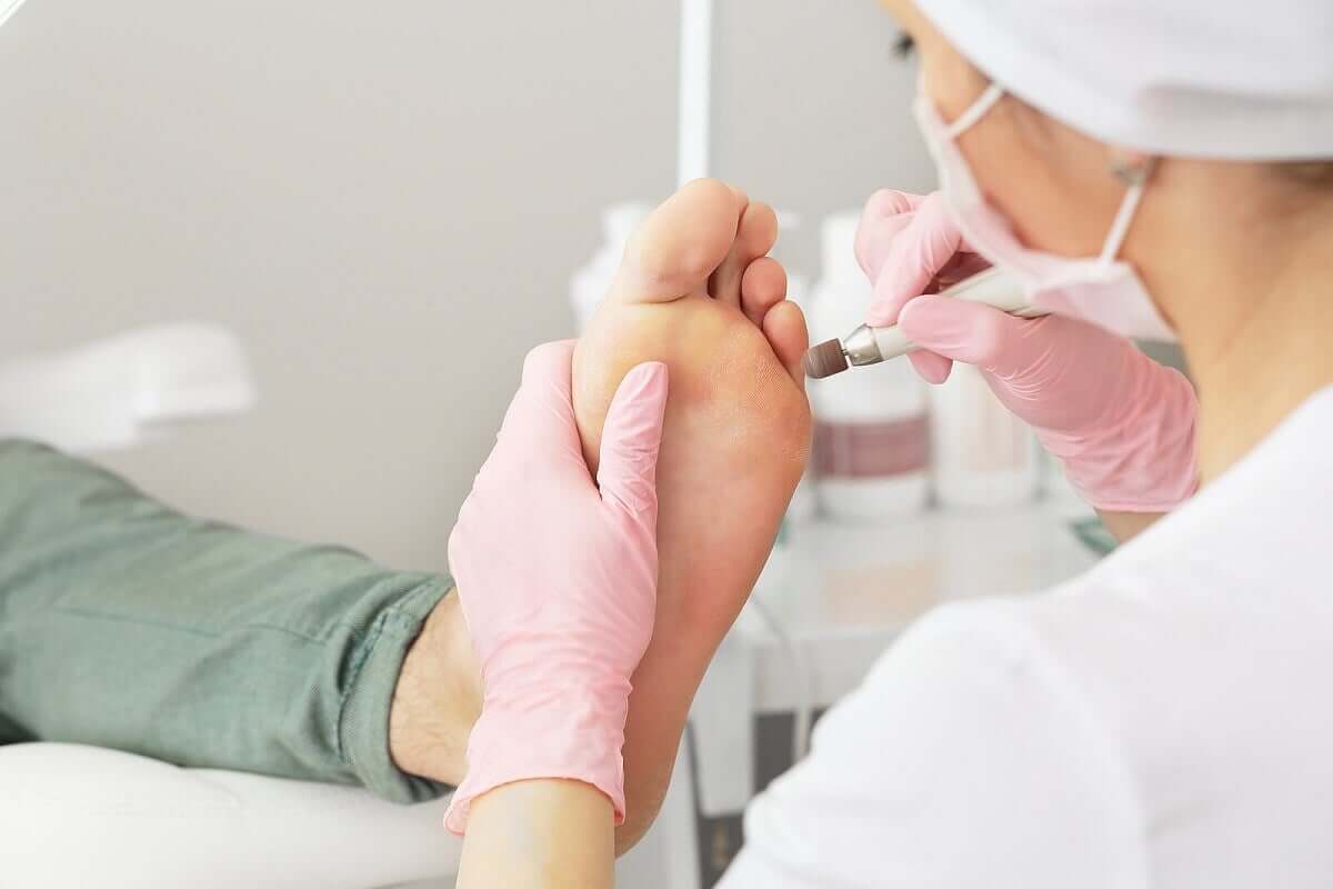 Calluses on hands and feet.