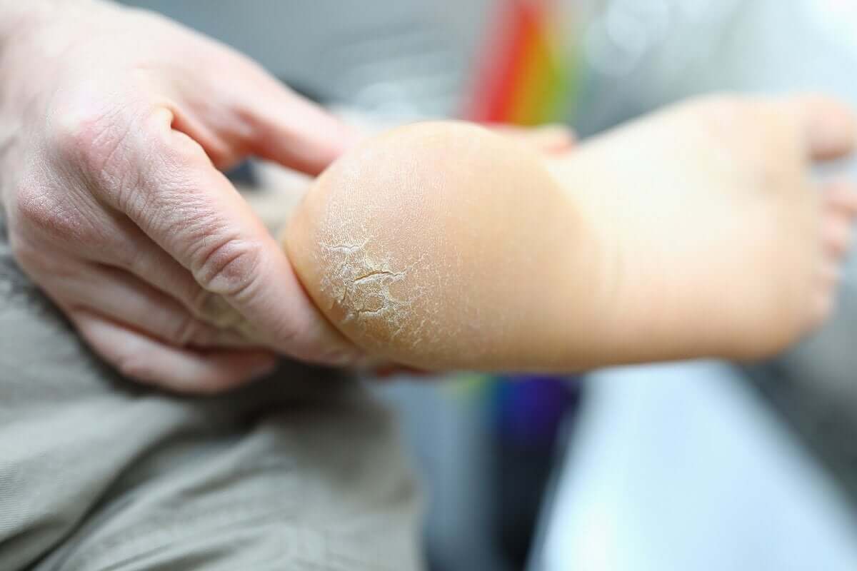 A foot with calluses.