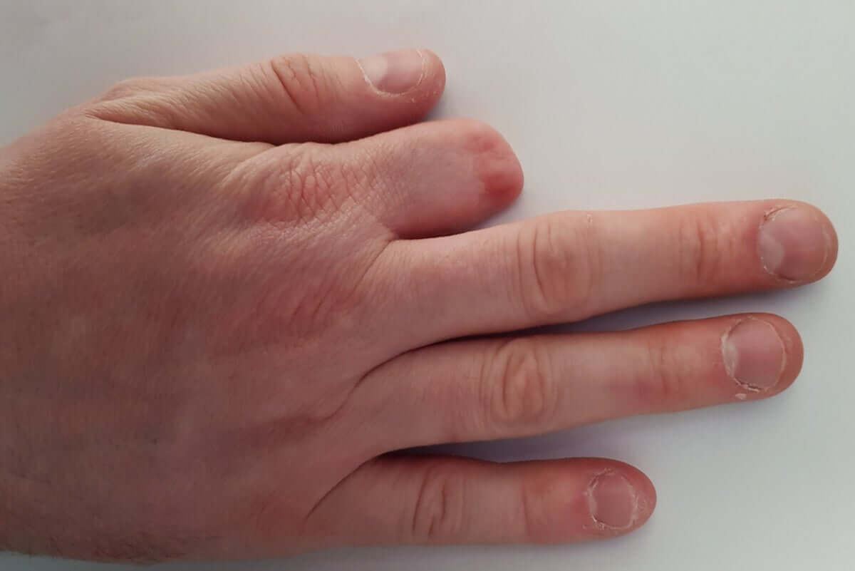 A hand with an amputated finger.