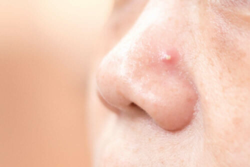 A nose with a pimple.