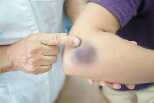 Characteristics of Henoch-Schönlein Purpura Disorder