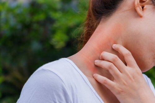 The Link Between Dermatitis and Corticosteroids