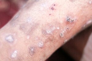 Causes, Symptoms and Treatments for Scabies