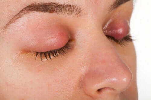Symptoms and Treatment of Eyelid Dandruff
